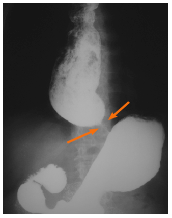 Tratamiento de acalasia - C. llerena