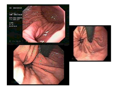 Tratamiento de Hernia Hiatal - M. Muñoz